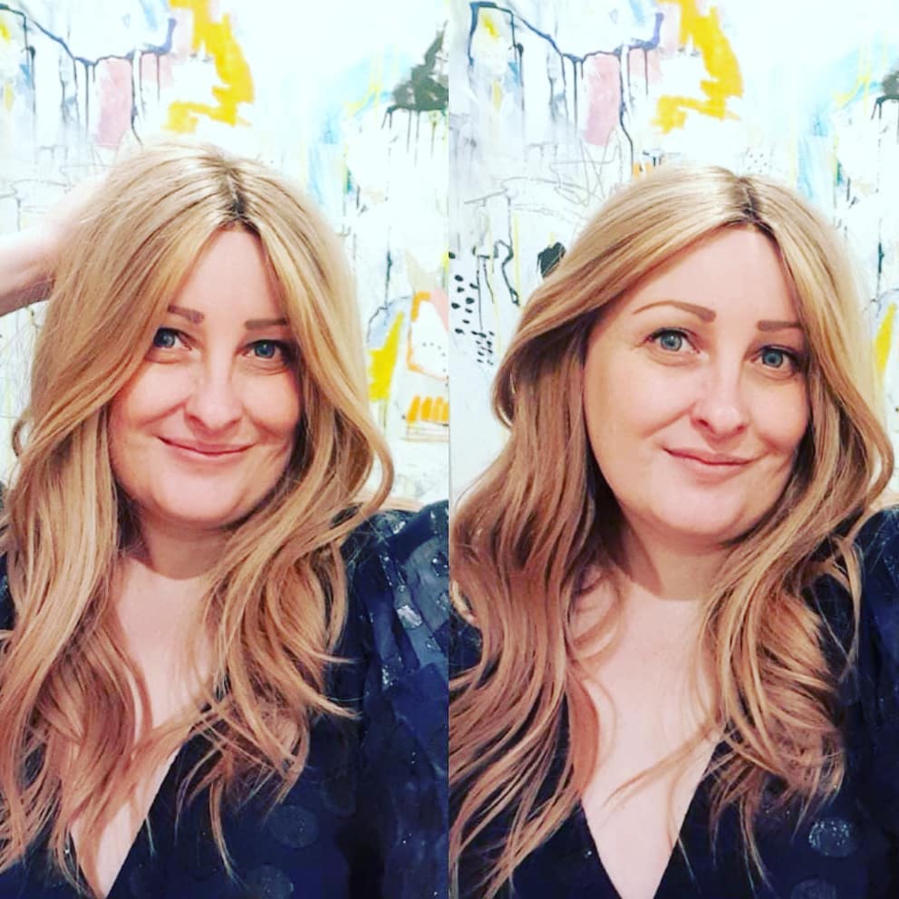 Hollie's Alopecia Story