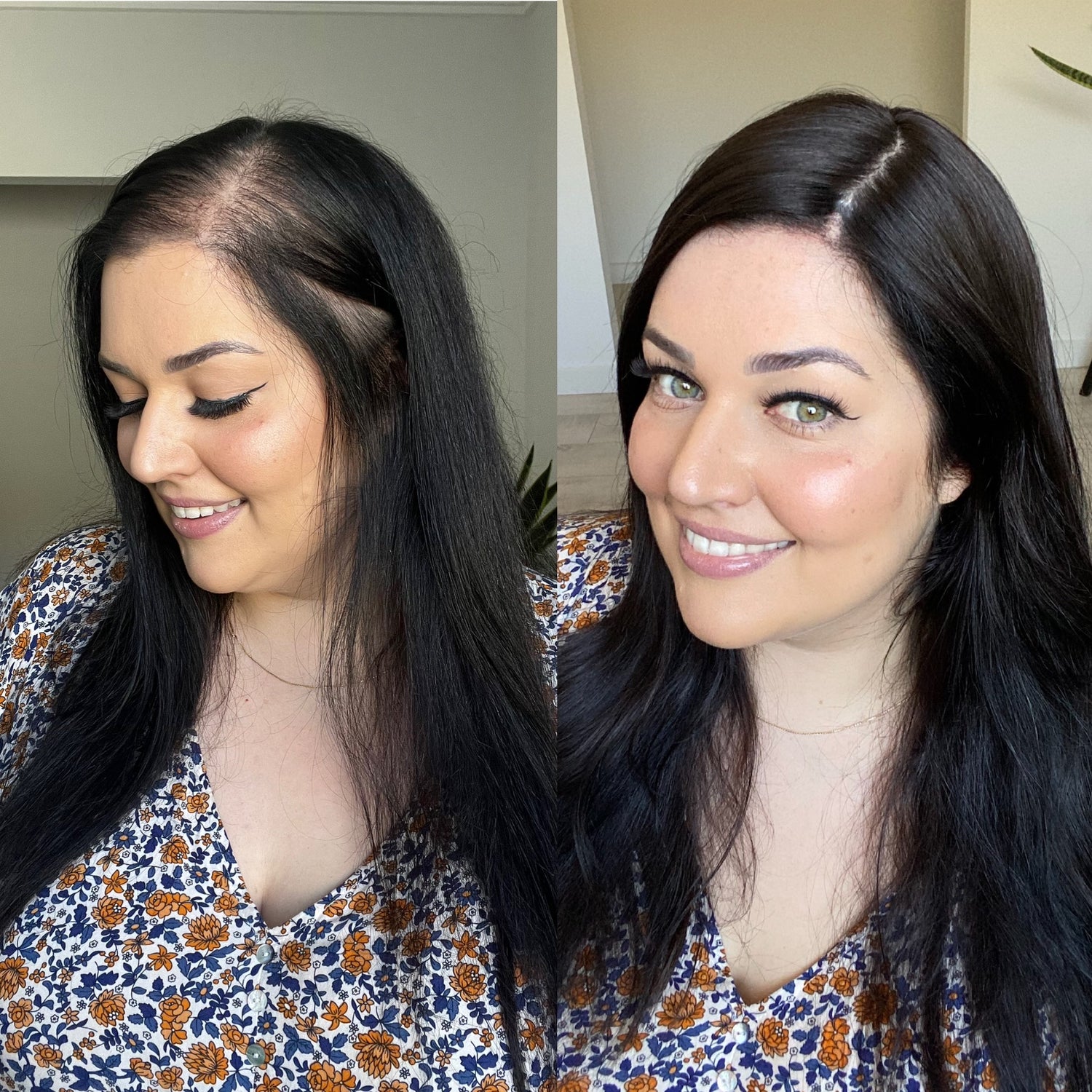 Is There a Cure for Hair Loss?