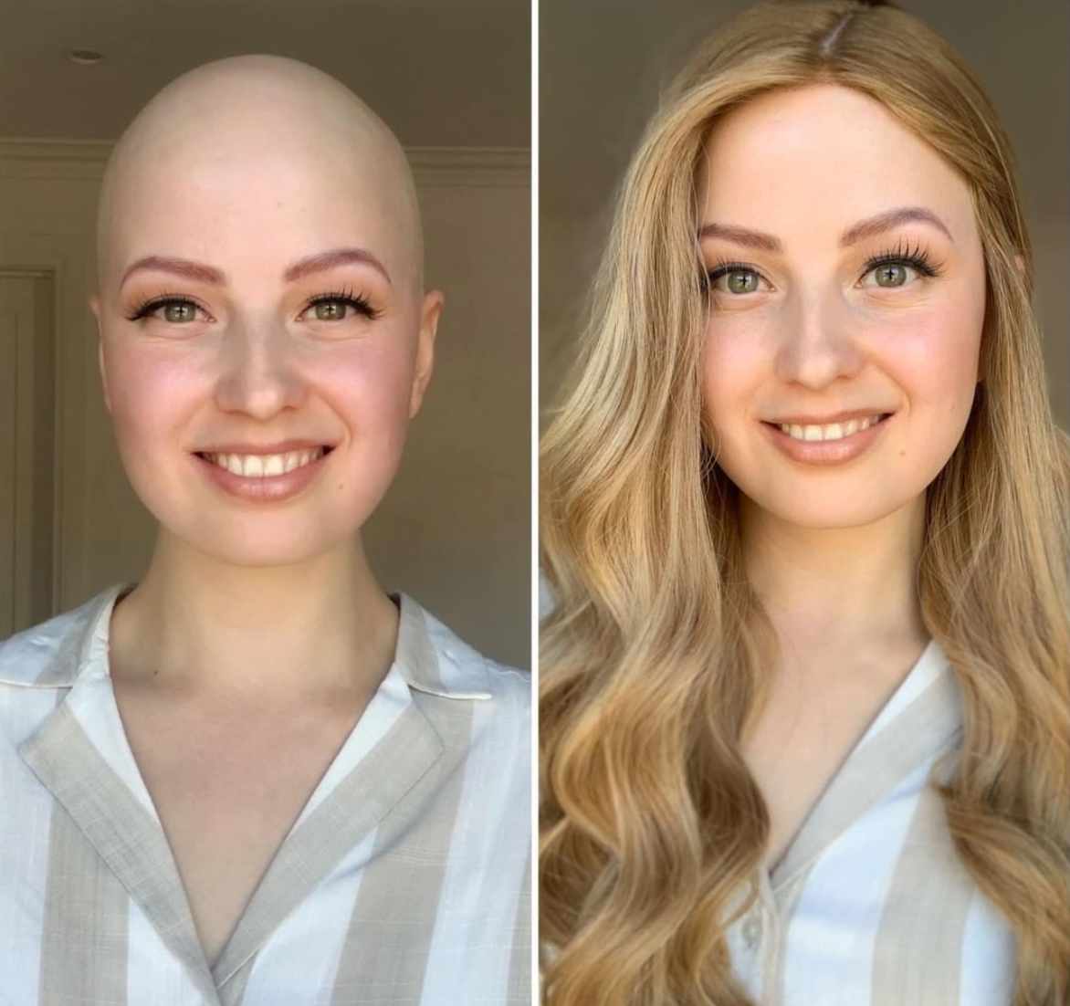 Holly's Alopecia Story: Wearing Wigs Since 5 Years Old