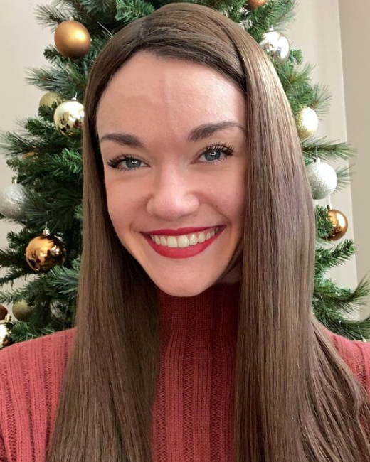 Hair Loss Stories: Clare