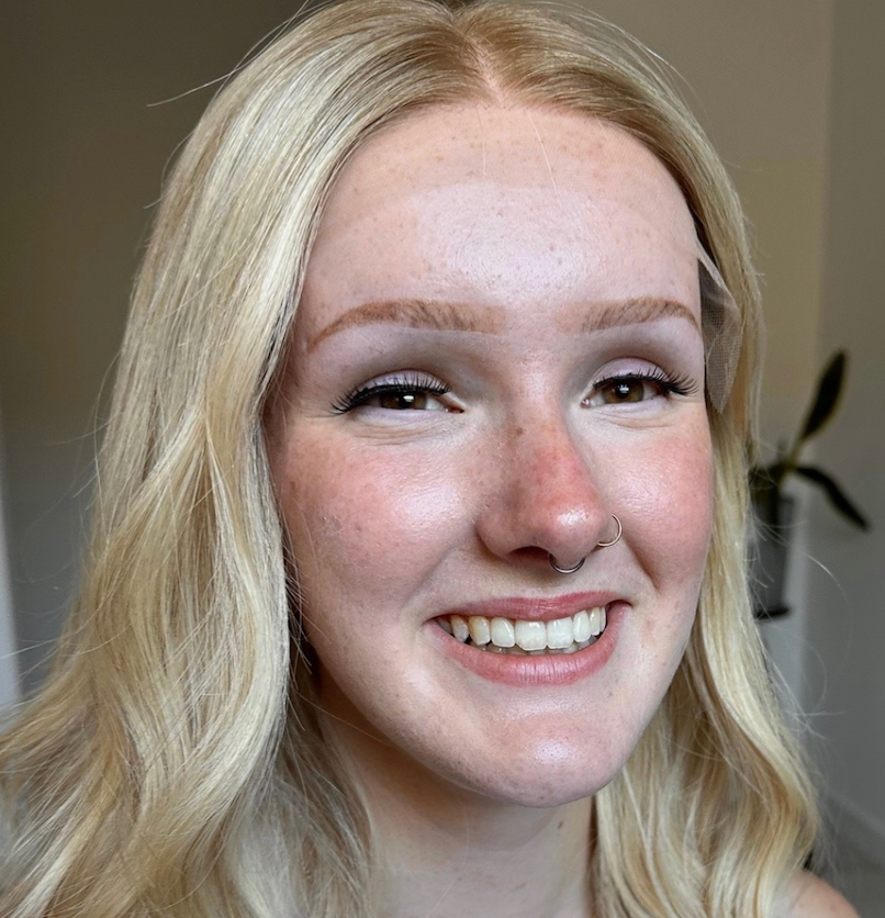 Hair Loss Stories: Lucy