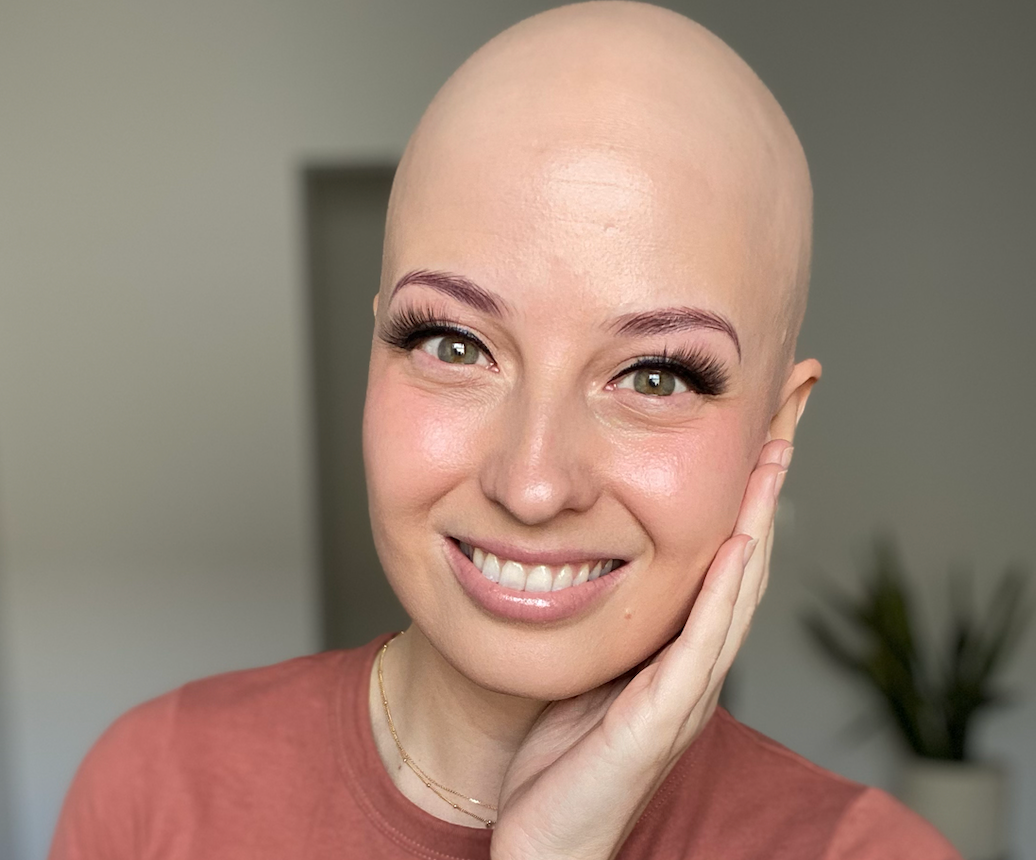 Finding Your Confidence Despite Hair Loss