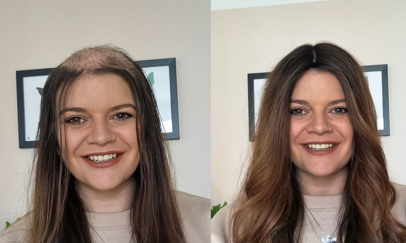 Everything You Need to Know About Trichotilomania