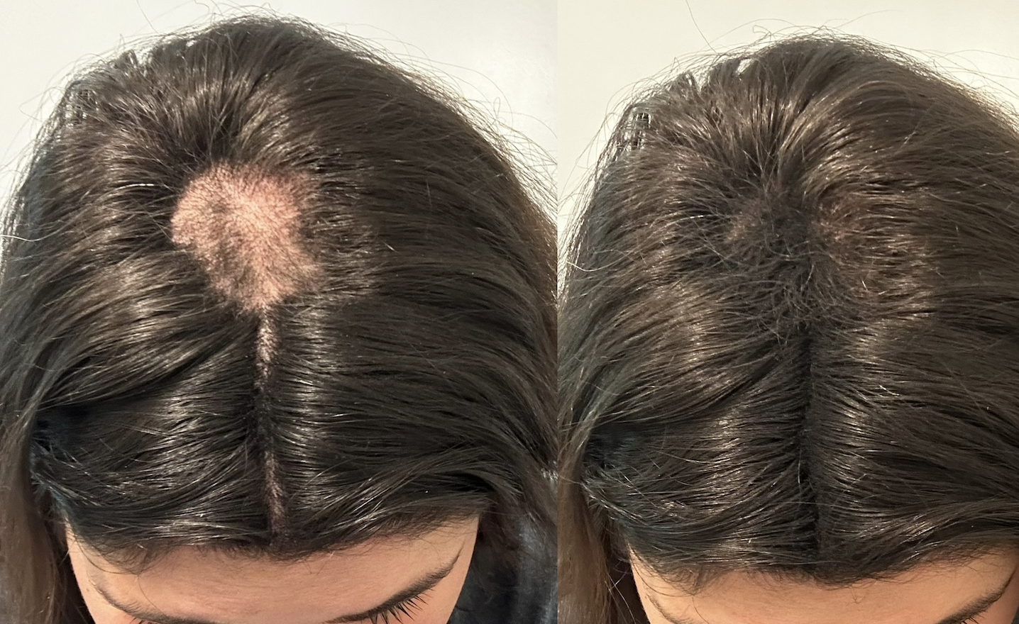 Everything You Need to Know About Post-Partum Hair Loss