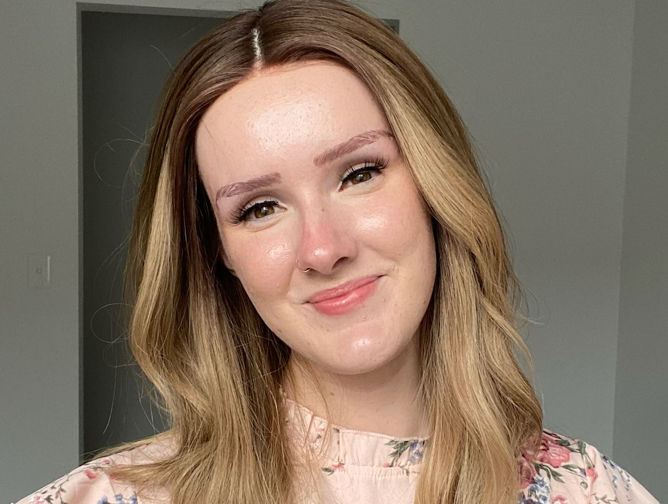 My Hair Fell Out Overnight.... Lucy's Hair Loss Journey