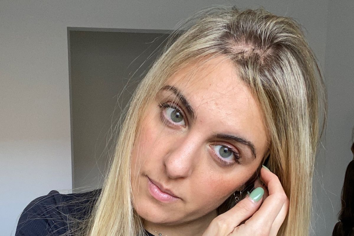 I Feel So Alone and Isolated With My Hair Loss