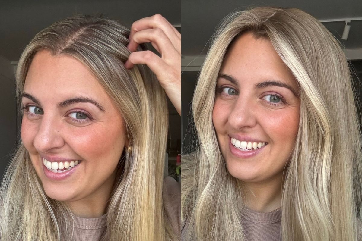 Kim's Hair Loss Story