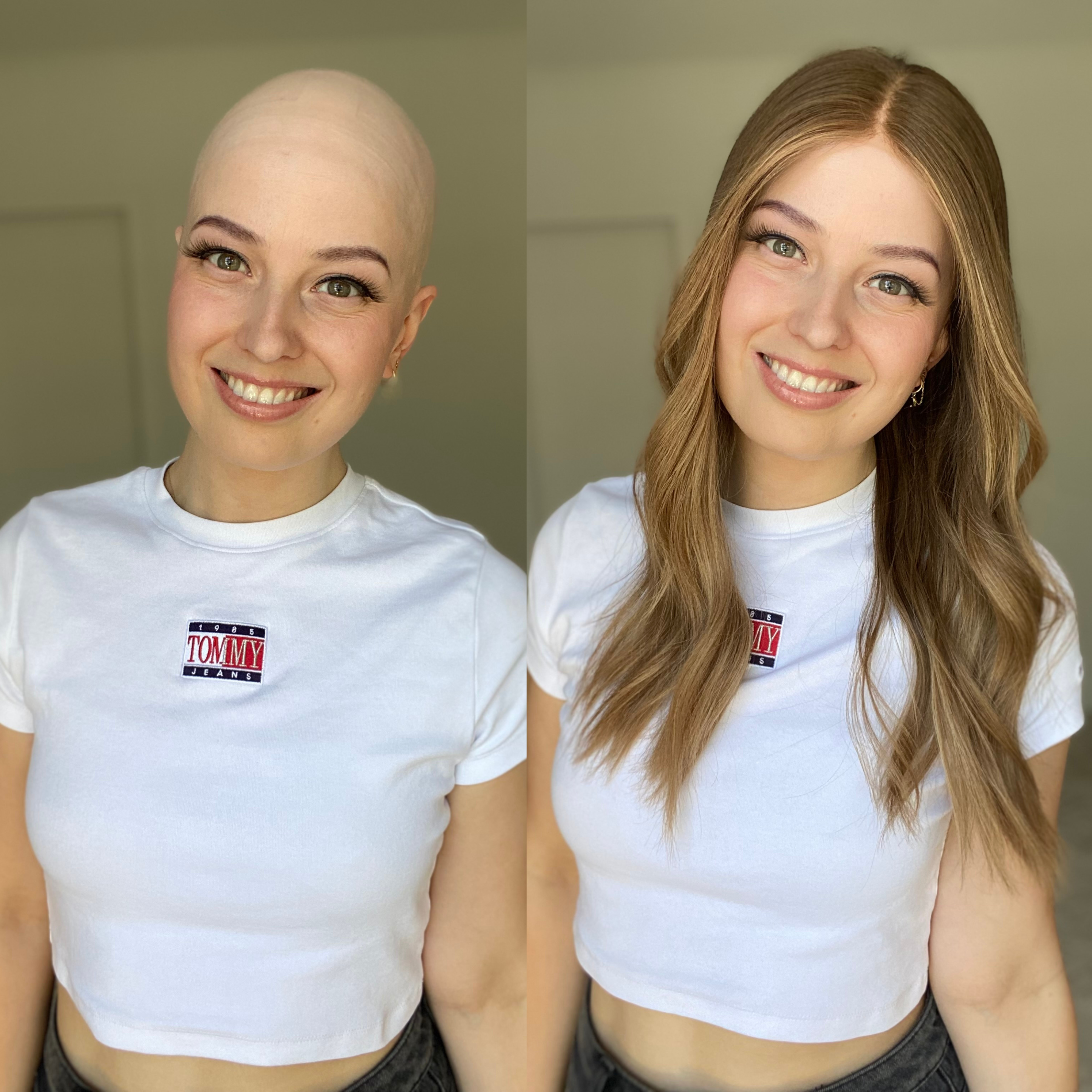 Wigs Helped Me to Come to Peace with My Hair Loss