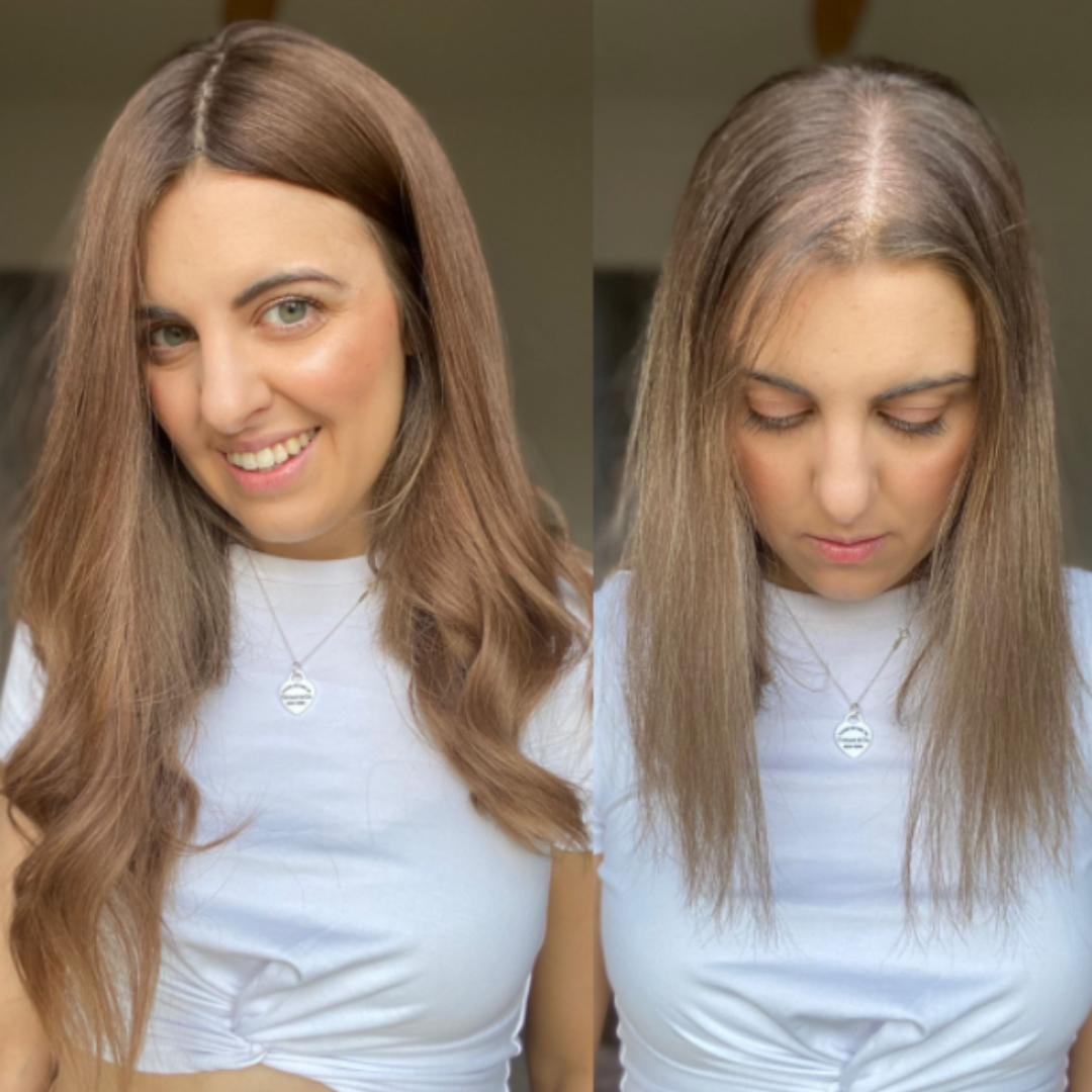 Kim's hair loss story