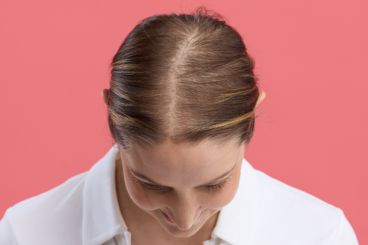 What is traction alopecia?