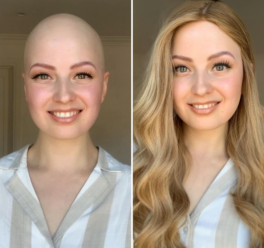 Holly's Alopecia Story: Wearing Wigs Since 5 Years Old