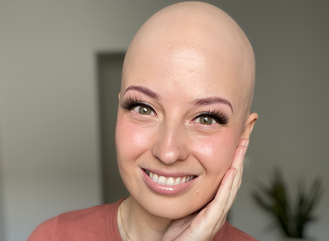 Is Alopecia Hereditary?