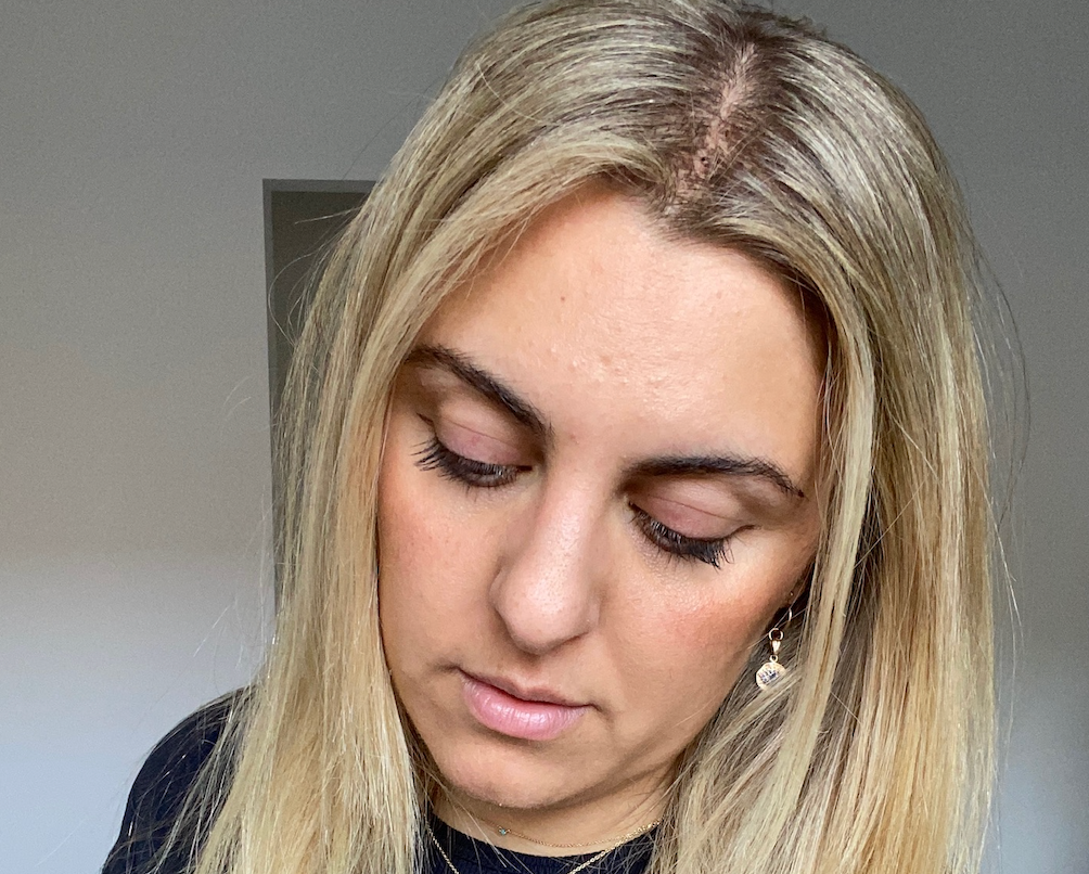 What medications cause hair loss in women?