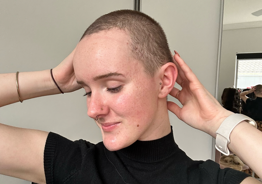 My Journey with Alopecia: Understanding, Accepting, and Embracing Life