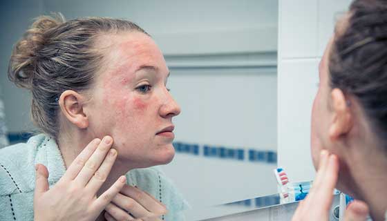 Lupus and Hair Loss: A Connection Worth Understanding